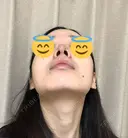 鼻尖形成（切開） / 軟骨移植 JUN CLINIC DAY 14 サムネイル用