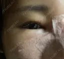 隆鼻術 / 鼻尖形成（切開） / 糸リフト / 軟骨移植 / ヒアルロン酸注入（頬） ASTRA BEAUTY CLINIC DAY 2 サムネイル用