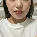 糸リフト / バッカルファット除去 / 脂肪吸引（顔） 湘南美容クリニック 京都院 DAY 16 サムネイル用