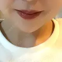 ボトックス（あご） / ヒアルロン酸注入（あご） ルラ美容クリニック 名古屋本院 AFTER サムネイル用