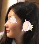 隆鼻術 / 鼻尖形成（切開） / 鼻中隔延長（切開） / 小鼻縮小（切開） / プロテーゼ除去 / 鼻尖縮小 FROM B整形外科 (旧バウム整形外科) DAY 47 サムネイル用