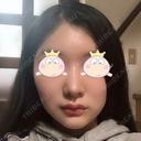 隆鼻術 / 鼻尖形成（切開） / 鼻中隔延長（切開） / 小鼻縮小（切開） / プロテーゼ除去 / 鼻尖縮小 FROM B整形外科 (旧バウム整形外科) DAY 47 サムネイル用