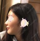 隆鼻術 / 鼻尖形成（切開） / 鼻中隔延長（切開） / 小鼻縮小（切開） / プロテーゼ除去 / 鼻尖縮小 FROM B整形外科 (旧バウム整形外科) DAY 47 サムネイル用