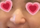 鼻尖形成（切開） / 鼻中隔延長（切開） / 鼻尖縮小 / 鼻柱下降・鼻唇角形成（猫手術） KAUNIS CLINIC（カウニスクリニック） DAY 30 サムネイル用