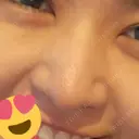 鼻尖形成（切開） / 鼻中隔延長（切開） / 鼻尖縮小 / 鼻柱下降・鼻唇角形成（猫手術） KAUNIS CLINIC（カウニスクリニック） DAY 55 サムネイル用