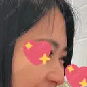 鼻尖形成（切開） / 鼻中隔延長（切開） / 鼻尖縮小 / 鼻柱下降・鼻唇角形成（猫手術） KAUNIS CLINIC（カウニスクリニック） DAY 37 サムネイル用