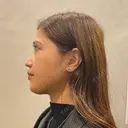 インディバ（顔） WOM SALON【術後ケア取扱いサロン】 AFTER サムネイル用