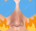 隆鼻術 / 鼻尖形成（切開） / 糸リフト / 軟骨移植 / ヒアルロン酸注入（頬） ASTRA BEAUTY CLINIC DAY 5 サムネイル用