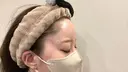 ヒアルロン酸注入（額） / ヒアルロン酸注入（こめかみ） 渋谷美容外科クリニック 新宿院 DAY 0 サムネイル用
