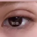 二重埋没 湘南美容クリニック 那覇院 DAY 3 サムネイル用