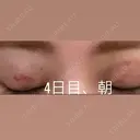 二重埋没 湘南美容クリニック 那覇院 DAY 4 サムネイル用
