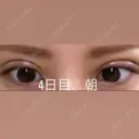 二重埋没 湘南美容クリニック 那覇院 DAY 4 サムネイル用
