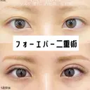 二重埋没 湘南美容クリニック 那覇院 AFTER サムネイル用
