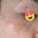 シミ取りレーザー Jスキンクリニック 【J-SKIN clinic】 DAY 10 サムネイル用