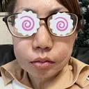 糸リフト / ジョールファット除去 ルラ美容クリニック 大阪本院 DAY 1 サムネイル用