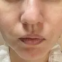 糸リフト / ジョールファット除去 高崎美容クリニック DAY 3 サムネイル用
