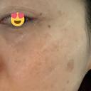 シミ取りレーザー Jスキンクリニック 【J-SKIN clinic】 DAY 13 サムネイル用