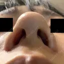 小鼻縮小（切開） 山本クリニック DAY 30 サムネイル用