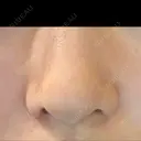 小鼻縮小（切開） 山本クリニック DAY 30 サムネイル用