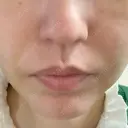 糸リフト / ジョールファット除去 高崎美容クリニック DAY 4 サムネイル用