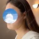 糸リフト / 骨切り（あご） / 骨削り（エラ） / 脂肪吸引（顔） 銀座マイアミ美容外科 DAY 7 サムネイル用