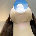 糸リフト / 骨切り（あご） / 骨削り（エラ） / 脂肪吸引（顔） 銀座マイアミ美容外科 DAY 7 サムネイル用