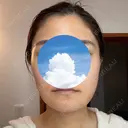 糸リフト / 骨切り（あご） / 骨削り（エラ） / 脂肪吸引（顔） 銀座マイアミ美容外科 DAY 8 サムネイル用