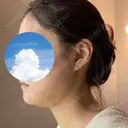 糸リフト / 骨切り（あご） / 骨削り（エラ） / 脂肪吸引（顔） 銀座マイアミ美容外科 DAY 8 サムネイル用