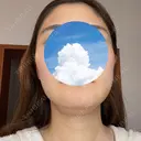 糸リフト / 骨切り（あご） / 骨削り（エラ） / 脂肪吸引（顔） 銀座マイアミ美容外科 DAY 10 サムネイル用