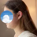 糸リフト / 骨切り（あご） / 骨削り（エラ） / 脂肪吸引（顔） 銀座マイアミ美容外科 DAY 10 サムネイル用