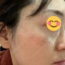シミ取りレーザー Jスキンクリニック 【J-SKIN clinic】 DAY 15 サムネイル用