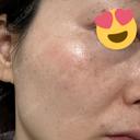 シミ取りレーザー Jスキンクリニック 【J-SKIN clinic】 AFTER サムネイル用