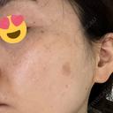 シミ取りレーザー Jスキンクリニック 【J-SKIN clinic】 DAY 15 サムネイル用