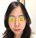 鼻尖形成（切開） / 軟骨移植 JUN CLINIC DAY 33 サムネイル用