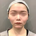 糸リフト / バッカルファット除去 / 脂肪吸引（顔） / ボトックス（あご） / ヒアルロン酸注入（あご） / ボトックス（エラ・小顔） / ヒアルロン酸注入（唇） / その他（口元） アリエル美容クリニック 大宮院 AFTER サムネイル用