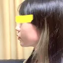 下まぶたたるみ取り / ヒアルロン酸注入（あご） / ボトックス（エラ・小顔） コスメディカルクリニック シンシア 銀座院 DAY 2 サムネイル用