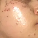 シミ取りレーザー / ピコスポット Olino美容外科・美容皮膚科 DAY 0 サムネイル用