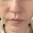 糸リフト / ジョールファット除去 高崎美容クリニック DAY 8 サムネイル用
