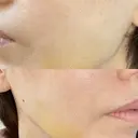 糸リフト / ジョールファット除去 高崎美容クリニック DAY 8 サムネイル用