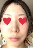 ピコレーザートーニング（美白・肝斑） PTクリニック六本木 DAY 4 サムネイル用