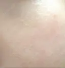 美容点滴・美容注射（美肌） / その他（肌） チョンダムジュエンクリニック AFTER サムネイル用