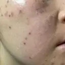 シミ取りレーザー / ピコスポット Olino美容外科・美容皮膚科 AFTER サムネイル用
