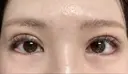 眼瞼下垂（切開） ステラ ロサ クリニック DAY 11 サムネイル用