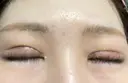 眼瞼下垂（切開） ステラ ロサ クリニック DAY 11 サムネイル用