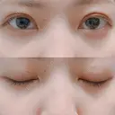 二重埋没 AILE Clinic DAY 21 サムネイル用