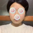 脂肪溶解注射（顔） 聖心美容クリニック 福岡院 AFTER サムネイル用