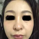 ピコレーザートーニング（美白・肝斑） ルラ美容クリニック 高田馬場院 AFTER サムネイル用