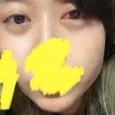 下まぶたたるみ取り / ヒアルロン酸注入（あご） / ボトックス（エラ・小顔） コスメディカルクリニック シンシア 銀座院 DAY 3 サムネイル用