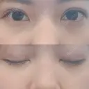 二重埋没 AILE Clinic DAY 22 サムネイル用