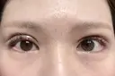 眼瞼下垂（切開） ステラ ロサ クリニック DAY 13 サムネイル用